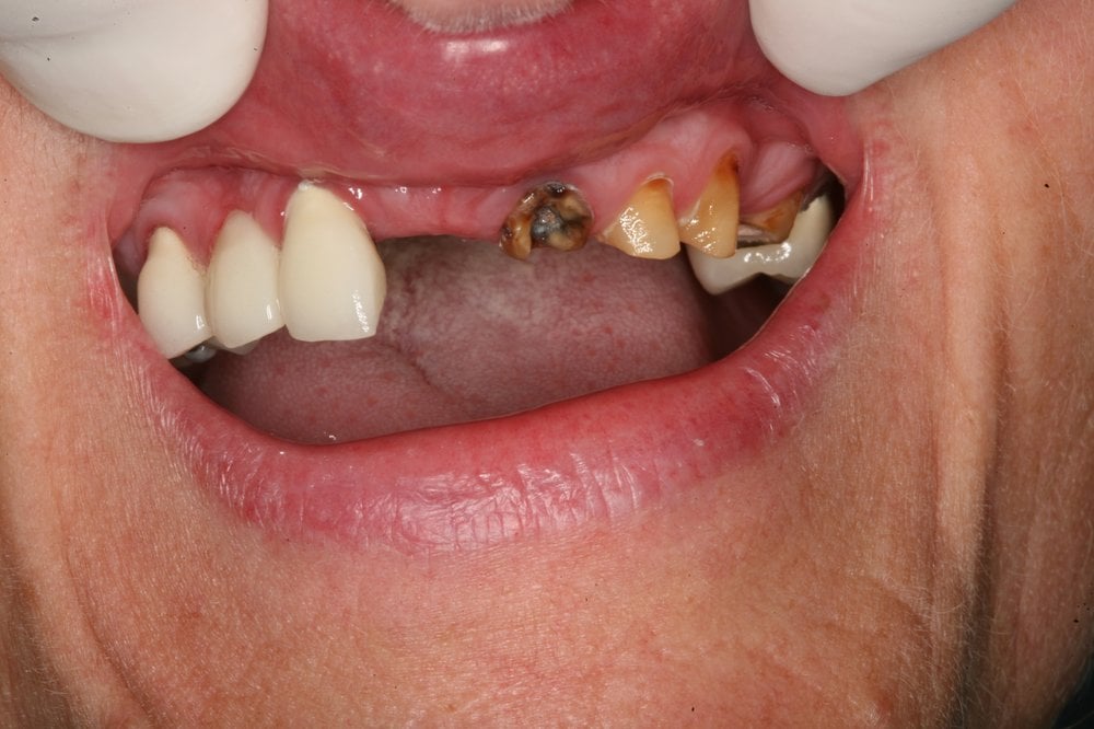 Before Missing & Decayed Teeth Yelp