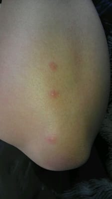 Castle Inn Suites Anaheim Bed Bugs Castle Inn Suites Anaheim Bed Bugs